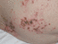 Herpes zoster (Корочки на месте высыпаний)